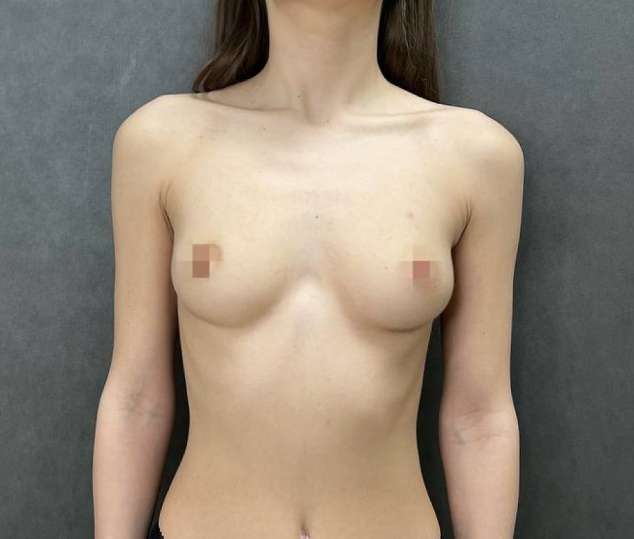 Увеличение груди, 1.5 мес., доктор Крылов М.С.