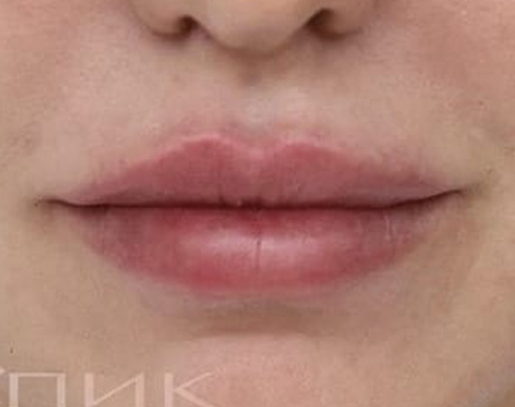 Контурная пластика губ, препарат Juvederm Ultra Smile 0,55 мл, доктор Скибан Ю. А.