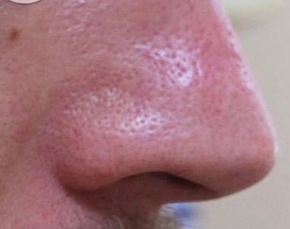 Результат удаления сосудов на крыльях носа, доктор Щитова И. А.