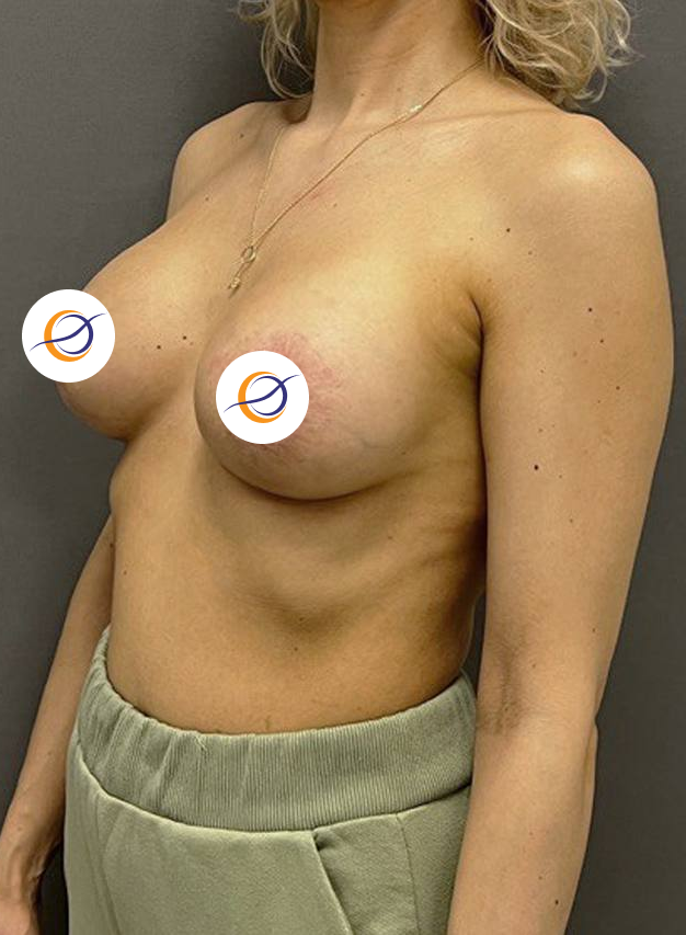 Ареолярная подтяжка тубулярной груди с имплантами, доктор Крылов М.С.