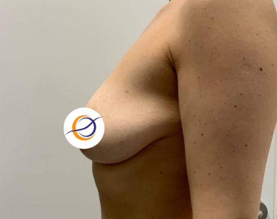 Т-образная подтяжка груди на имплантах, доктор Васильев Д.О.
