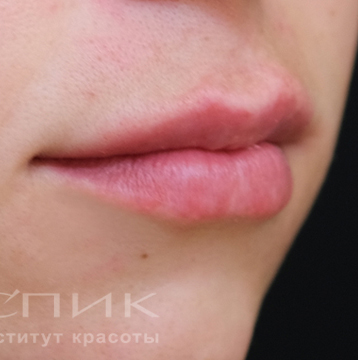 Контурная пластика губ, доктор Федоров Д. В.