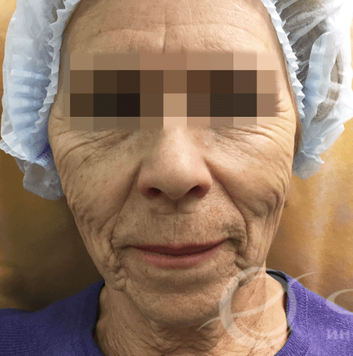 Лазерное омоложение кожи лица и шеи DekArt, доктор Бейнешев﻿ Р. С. 