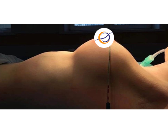 Увеличение груди анатомическими имплантами, доктор Юнусова Ю.Р.