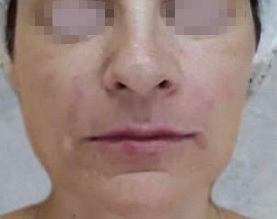 Коррекция средней трети лица, коррекция губ и носогубных складок, доктор Скибан Ю. А.